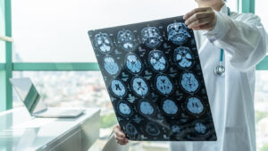 How Can the Team at Darrell Cochran Personal Injury Lawyer Help With a Brain Injury Claim in Seattle?