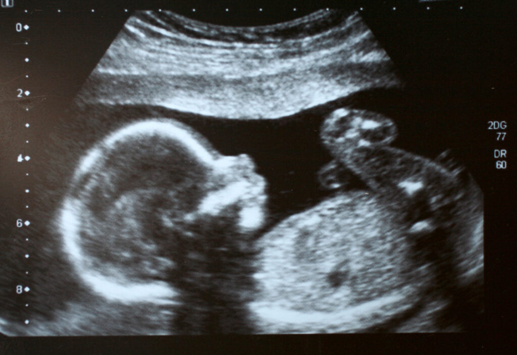 ultrasound of a baby