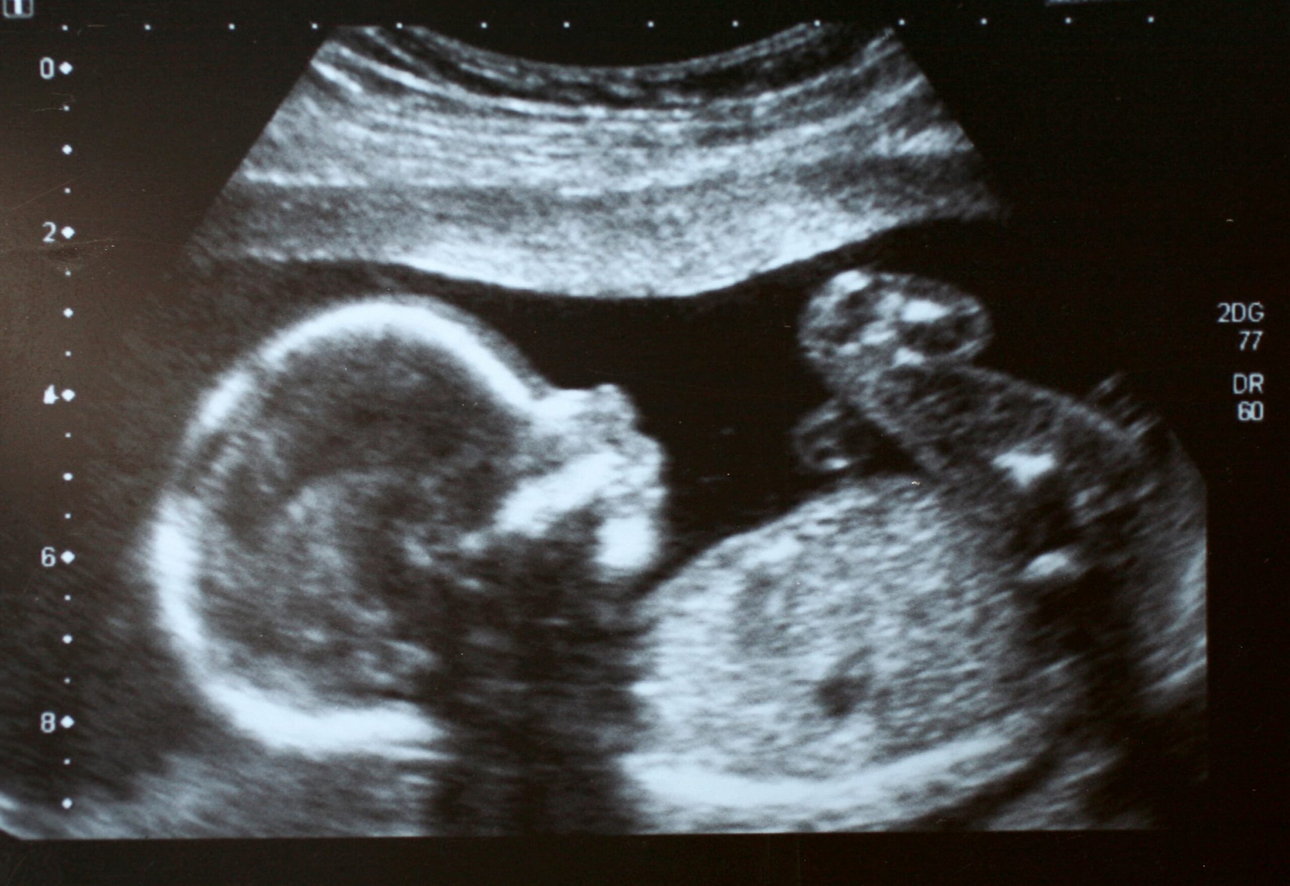 fetus ultrasound
